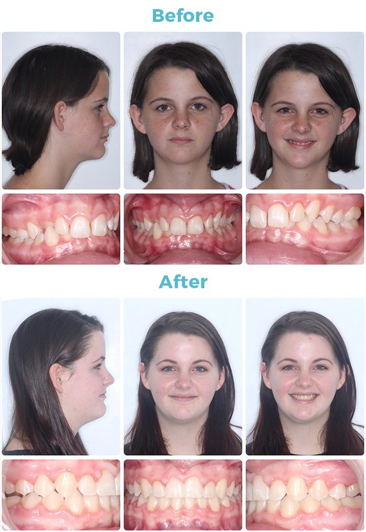 Before and After Patient Photo