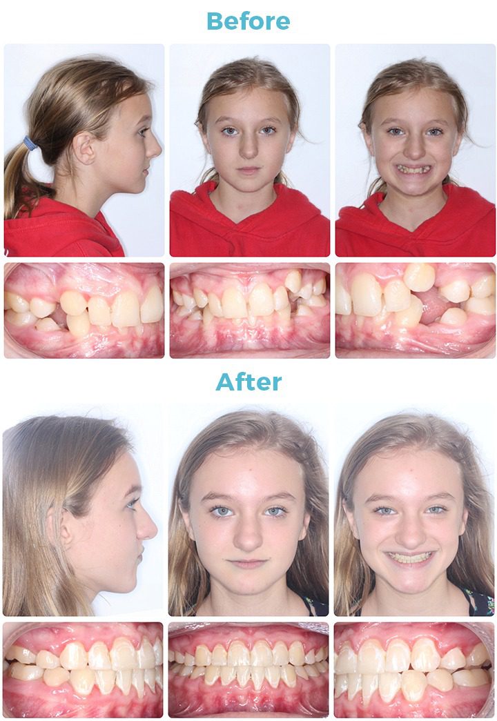 Before and After Patient Photo