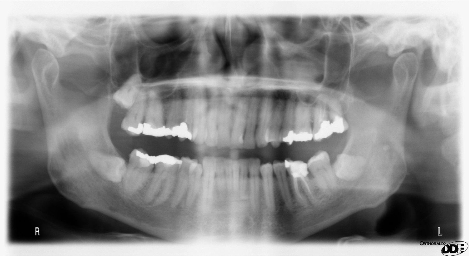 x-ray image of wisdom teeth