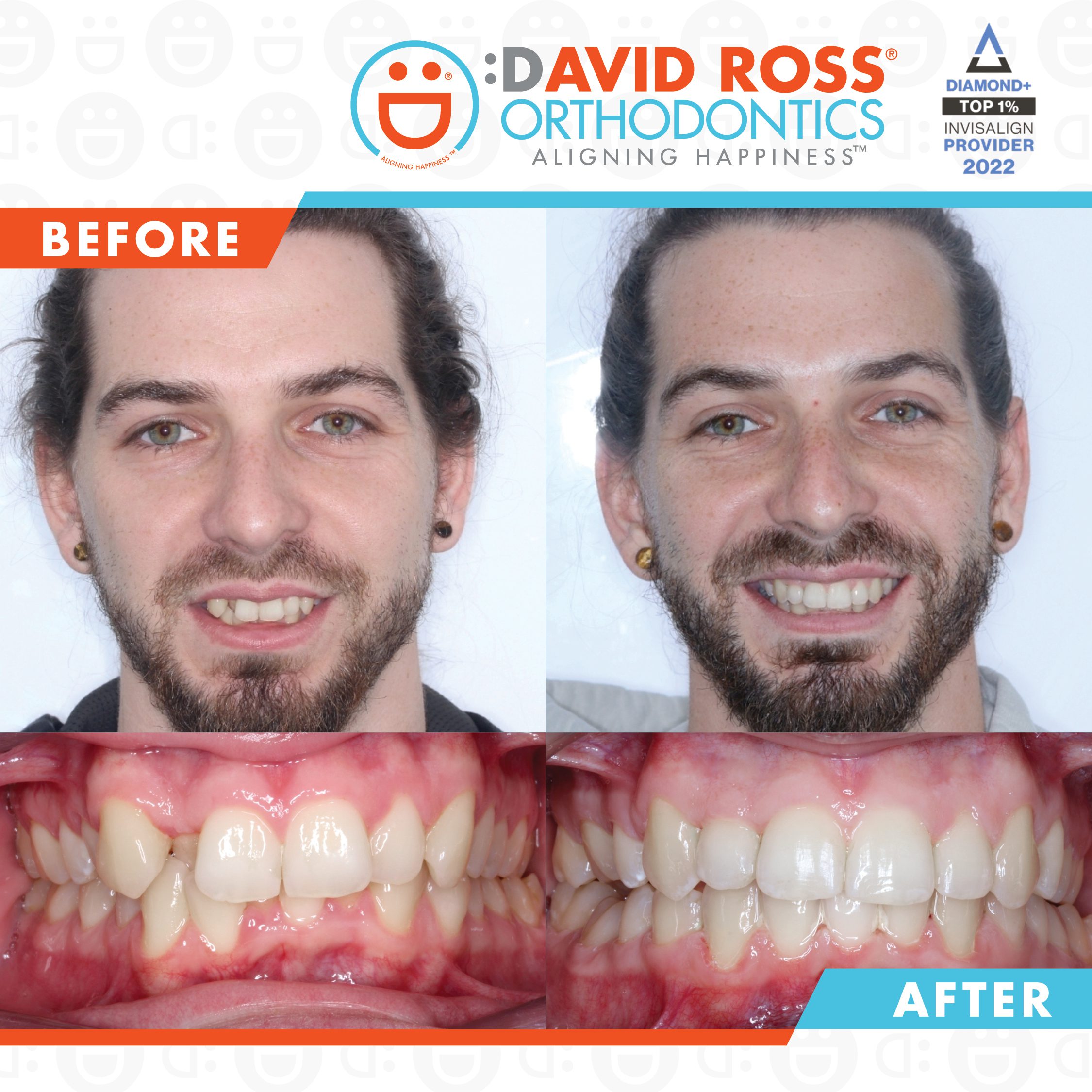Invisalign ® First clear aligners.