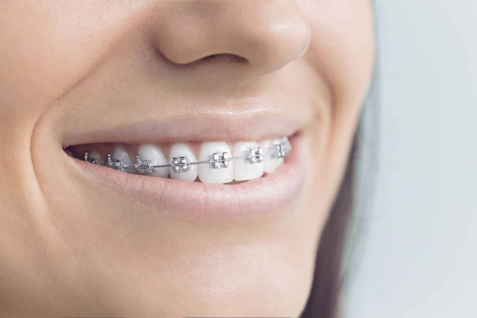 Can I Switch Orthodontists During Treatment? David Ross Orthodontics Hanover, PA, and Lutherville-Timonium and Westminster, MD