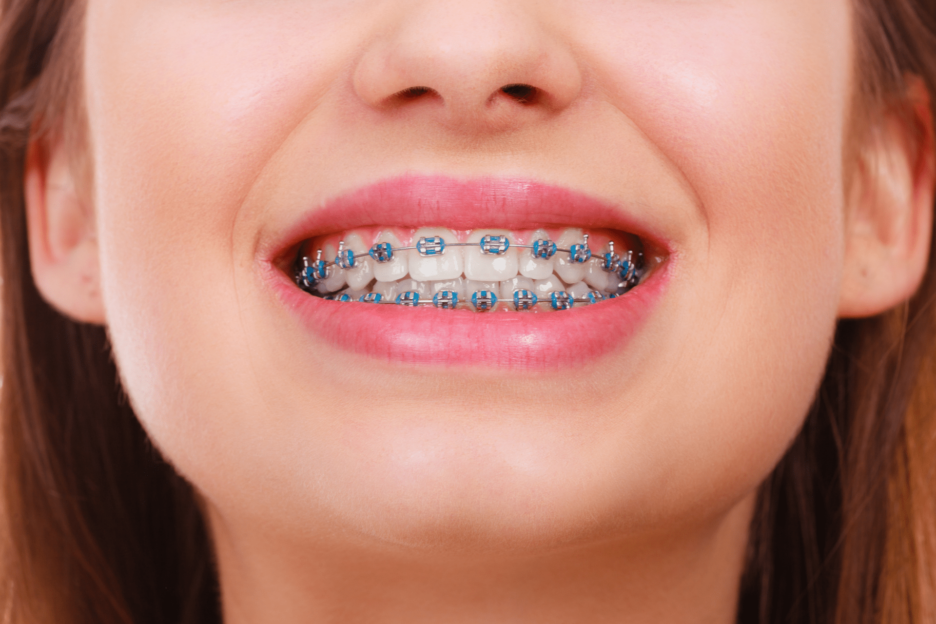Close-up of a person smiling with metal braces and blue bands.